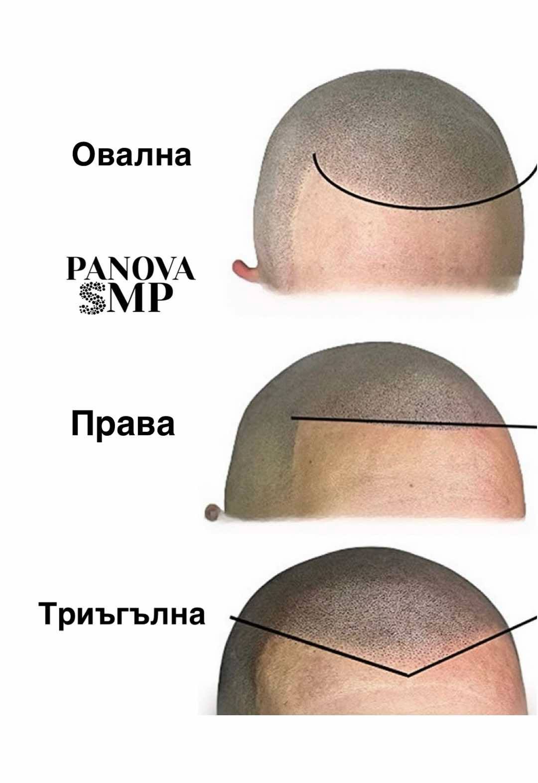 Какво става, ако не ти хареса резултатът от скалп микропигментация?